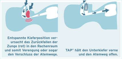 Schnarchtherapie in Hagen